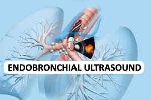 Endobronchial ultrasound eases TB diagnosis